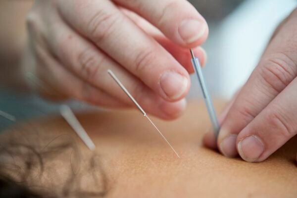 Dream About Acupuncture – Meaning And Symbol
